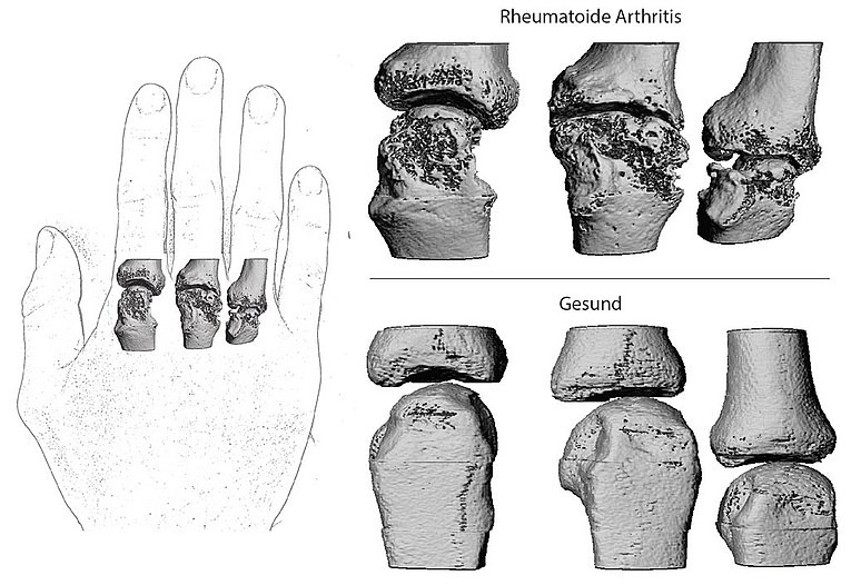 Konzept zur Entstehung einer Rheumatoiden Arthritis